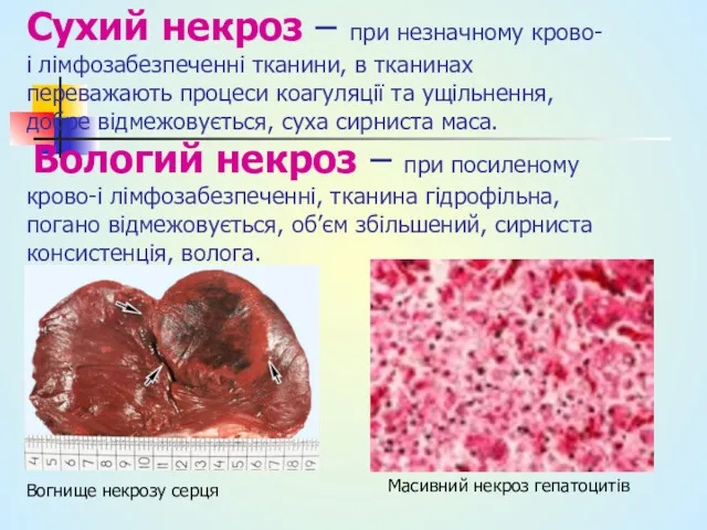 Сухий некроз – при незначному крово- і лімфозабезпеченні тканини, в тканинах переважають процеси