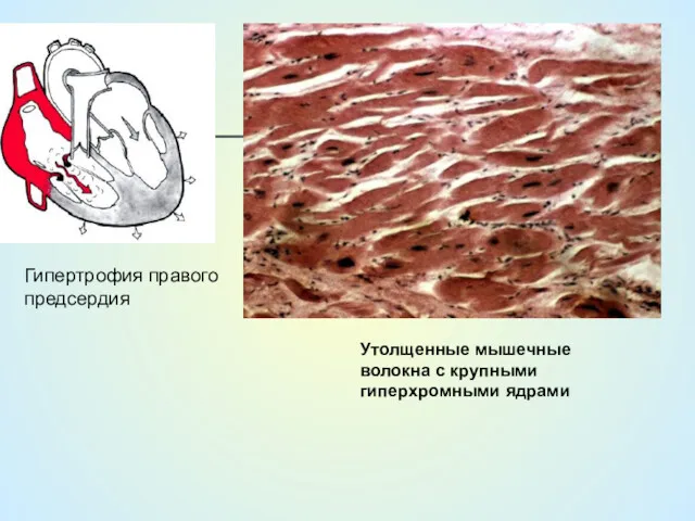 Гипертрофия правого предсердия Утолщенные мышечные волокна с крупными гиперхромными ядрами
