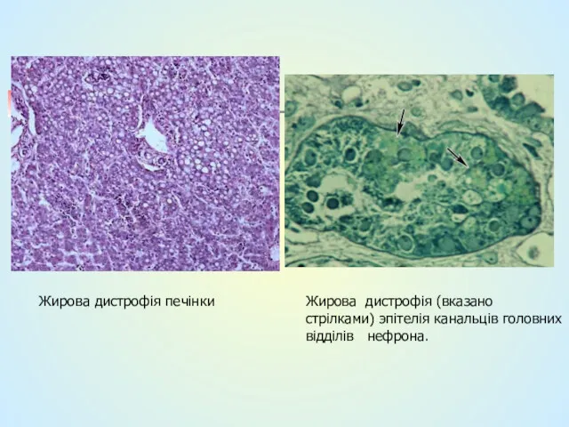 Жирова дистрофія печінки Жирова дистрофія (вказано стрілками) эпітелія канальців головних відділів нефрона.
