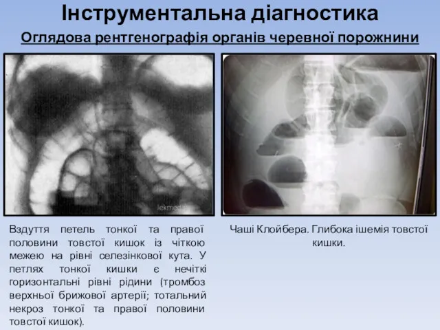 Інструментальна діагностика Оглядова рентгенографія органів черевної порожнини Вздуття петель тонкої