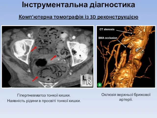 Інструментальна діагностика Комп’ютерна томографія із 3D реконструкцією Гіперпневматоз тонкої кишки.