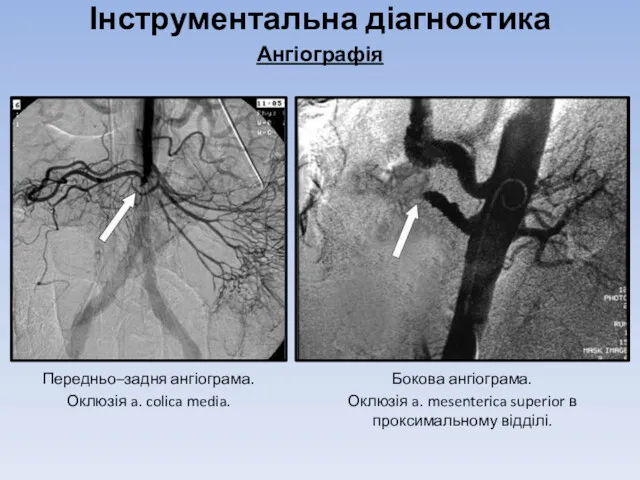 Інструментальна діагностика Ангіографія Передньо–задня ангіограма. Оклюзія a. colica media. Бокова