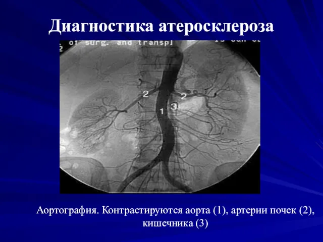 Диагностика атеросклероза Аортография. Контрастируются аорта (1), артерии почек (2), кишечника (3)