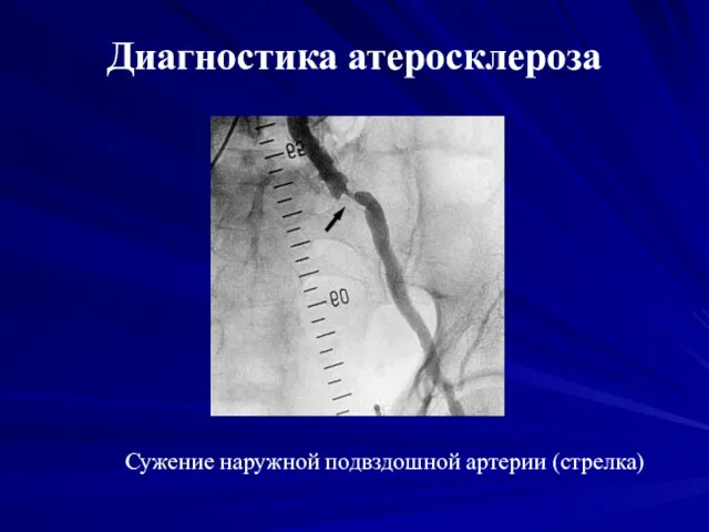 Диагностика атеросклероза Сужение наружной подвздошной артерии (стрелка)