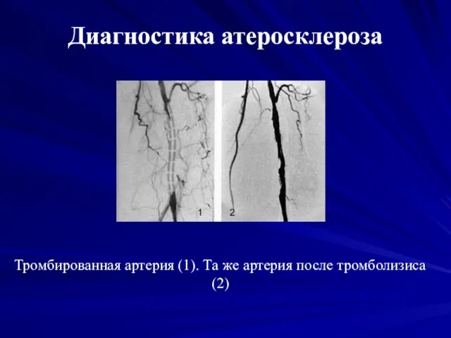 Диагностика атеросклероза Тромбированная артерия (1). Та же артерия после тромболизиса (2)