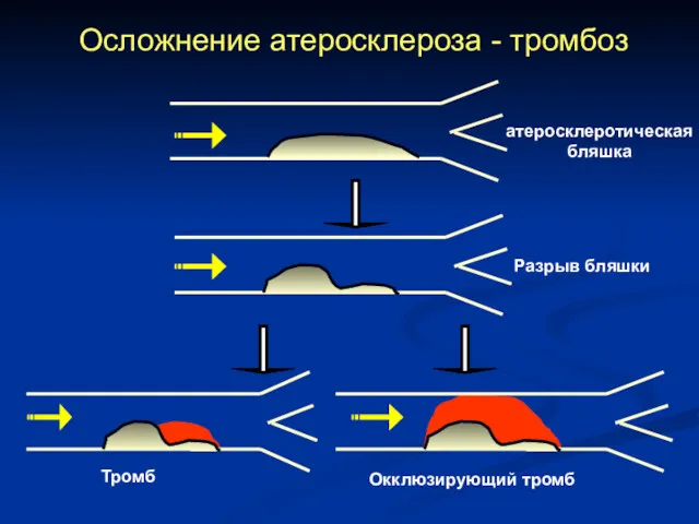 Осложнение атеросклероза - тромбоз атеросклеротическая бляшка Разрыв бляшки Тромб Окклюзирующий тромб