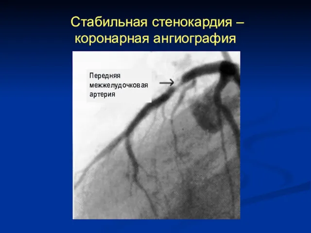 Стабильная стенокардия – коронарная ангиография Передняя межжелудочковая артерия