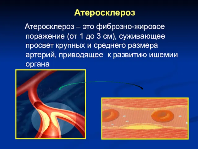 Атеросклероз Атеросклероз – это фиброзно-жировое поражение (от 1 до 3