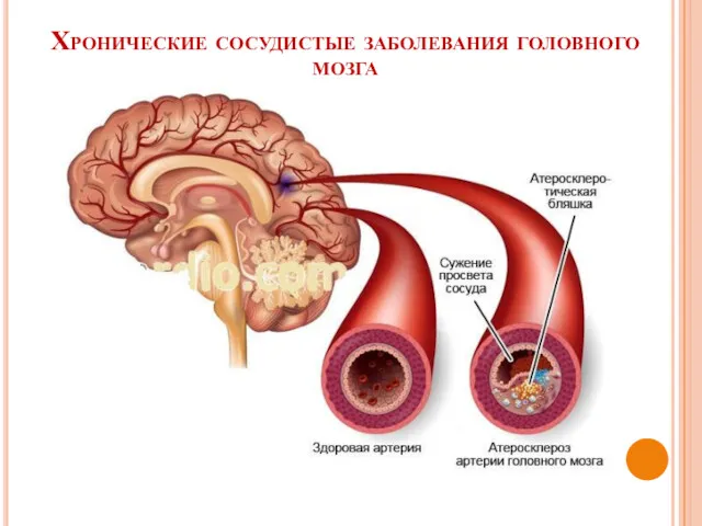 Хронические сосудистые заболевания головного мозга