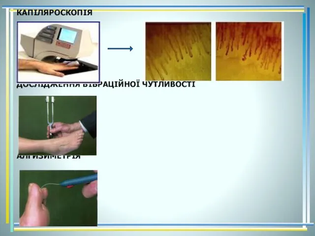 КАПІЛЯРОСКОПІЯ ДОСЛІДЖЕННЯ ВІБРАЦІЙНОЇ ЧУТЛИВОСТІ АЛГИЗИМЕТРІЯ