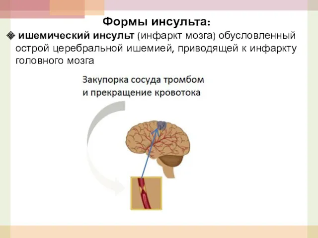 Формы инсульта: ишемический инсульт (инфаркт мозга) обусловленный острой церебральной ишемией, приводящей к инфаркту головного мозга