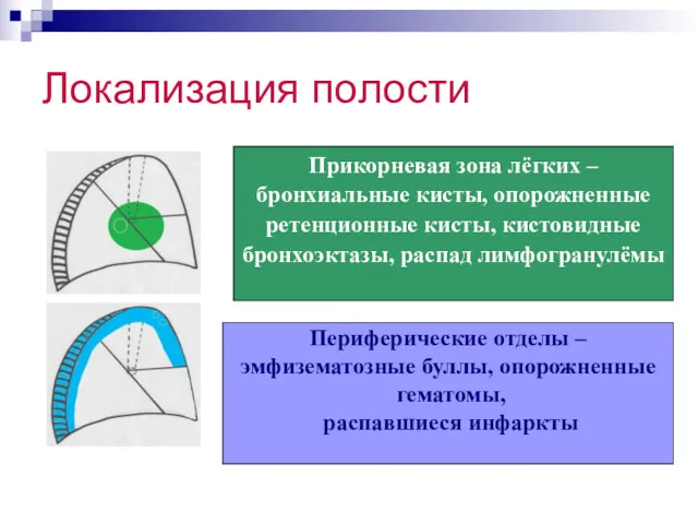 Локализация полости Прикорневая зона лёгких – бронхиальные кисты, опорожненные ретенционные