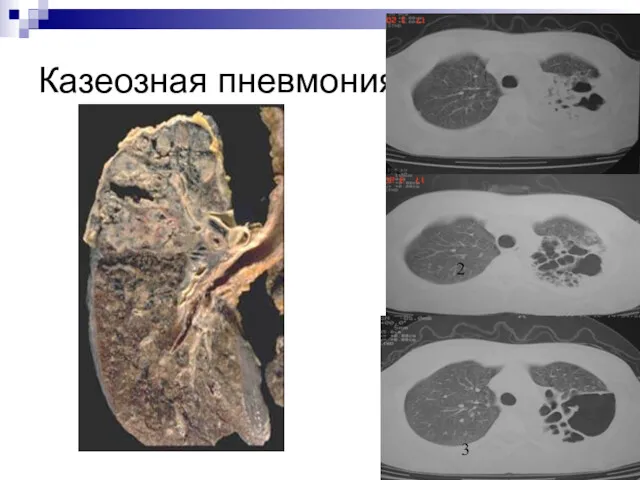 Казеозная пневмония 1 2 3