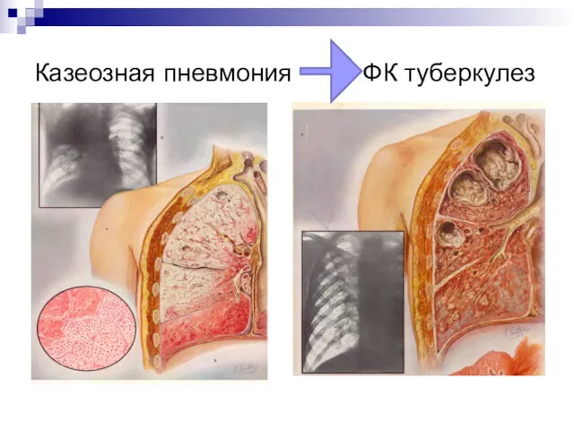 Казеозная пневмония ФК туберкулез