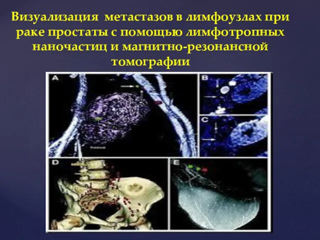 Визуализация метастазов в лимфоузлах при раке простаты с помощью лимфотропных наночастиц и магнитно-резонансной томографии