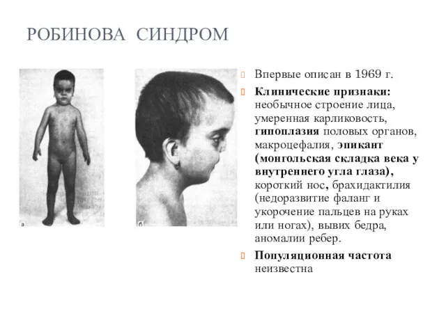 РОБИНОВА СИНДРОМ Впервые описан в 1969 г. Клинические признаки: необычное строение лица, умеренная