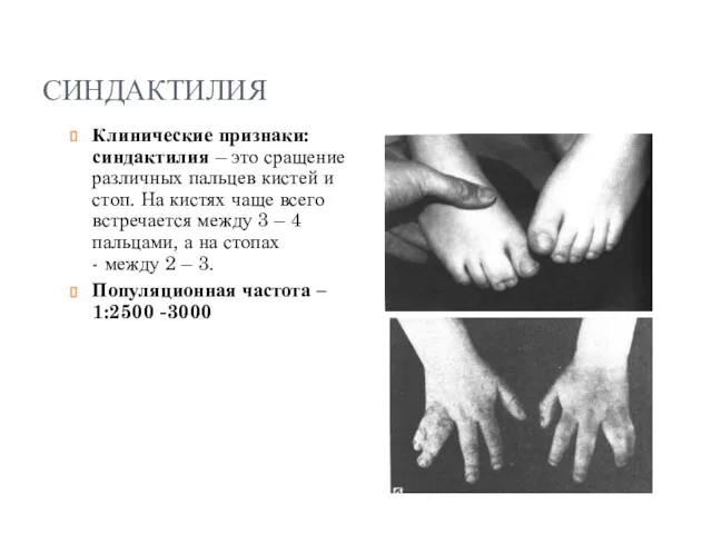 СИНДАКТИЛИЯ Клинические признаки: синдактилия – это сращение различных пальцев кистей и стоп. На