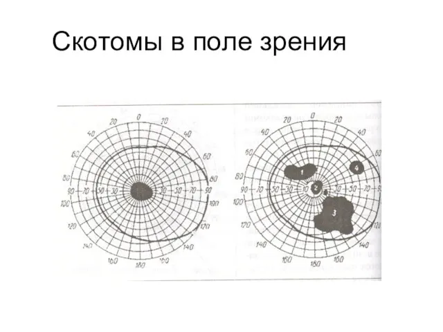 Скотомы в поле зрения