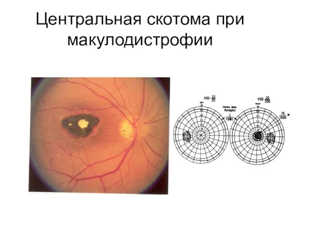 Центральная скотома при макулодистрофии