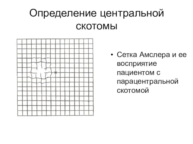 Определение центральной скотомы Сетка Амслера и ее восприятие пациентом с парацентральной скотомой