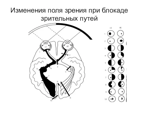 Изменения поля зрения при блокаде зрительных путей