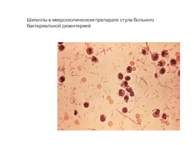 Шигеллы в микроскопическом препарате стула больного бактериальной дизентерией