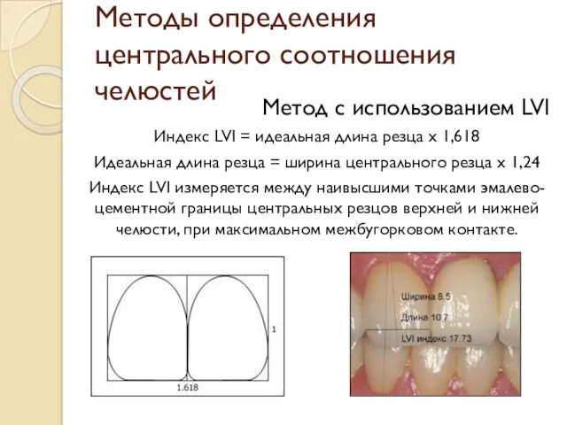 Методы определения центрального соотношения челюстей Метод с использованием LVI Индекс