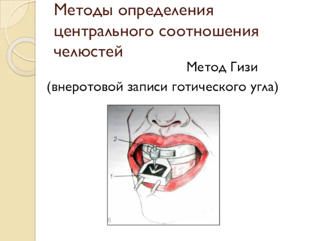 Методы определения центрального соотношения челюстей Метод Гизи (внеротовой записи готического угла)