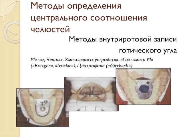 Методы определения центрального соотношения челюстей Методы внутриротовой записи готического угла