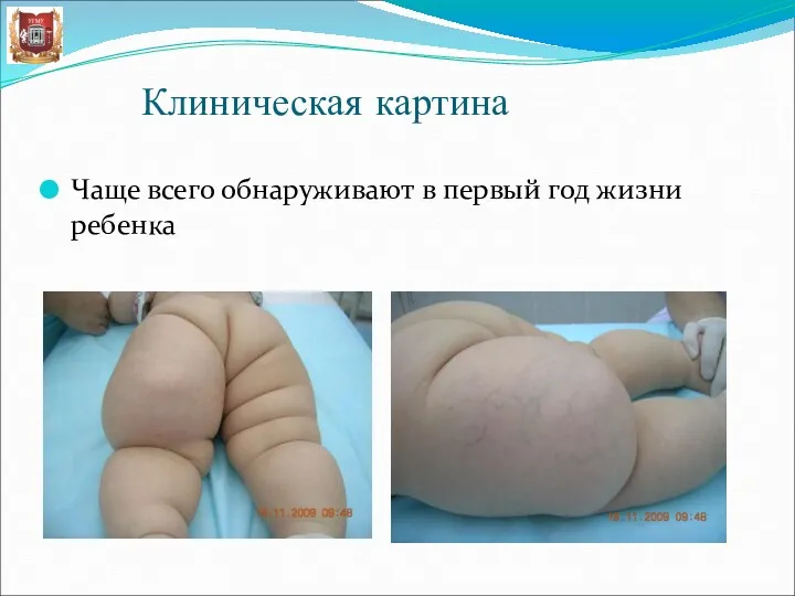 Клиническая картина Чаще всего обнаруживают в первый год жизни ребенка