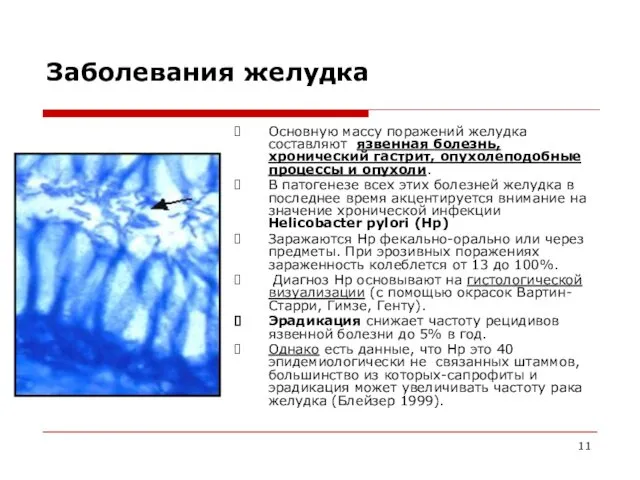 Заболевания желудка Основную массу поражений желудка составляют язвенная болезнь, хронический