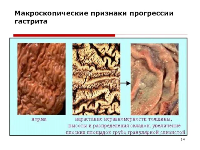 Макроскопические признаки прогрессии гастрита