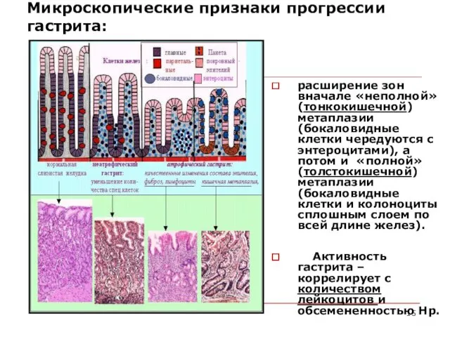 Микроскопические признаки прогрессии гастрита: расширение зон вначале «неполной» (тонкокишечной) метаплазии