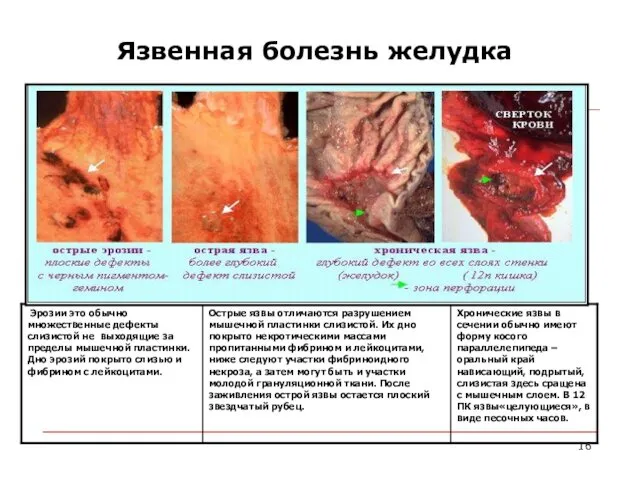 Язвенная болезнь желудка