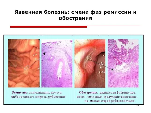 Язвенная болезнь: смена фаз ремиссии и обострения