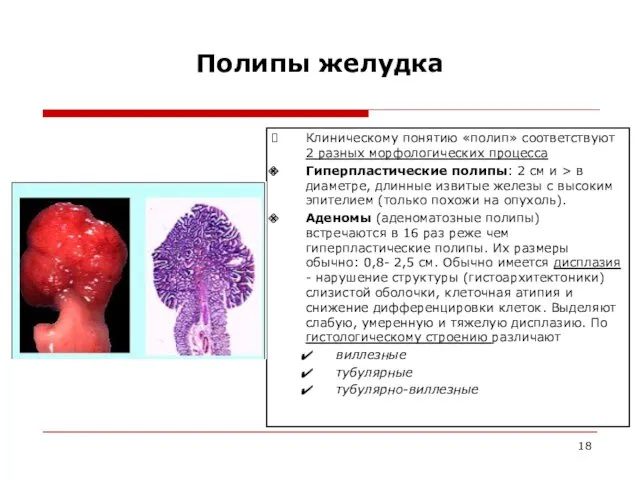 Полипы желудка Клиническому понятию «полип» соответствуют 2 разных морфологических процесса