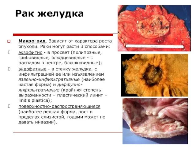 Рак желудка Макро-вид. Зависит от характера роста опухоли. Раки могут