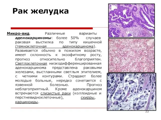 Рак желудка Микро-вид. Различные варианты аденокарциномы: более 50% случаев раковая