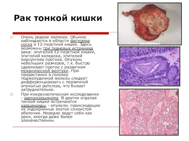 Рак тонкой кишки Очень редкое явление. Обычно наблюдается в области