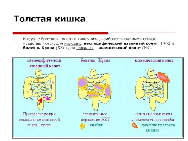 Толстая кишка В группе болезней толстого кишечника, наиболее значимыми сейчас