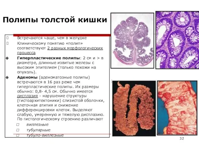 Полипы толстой кишки Встречаются чаще, чем в желудке Клиническому понятию