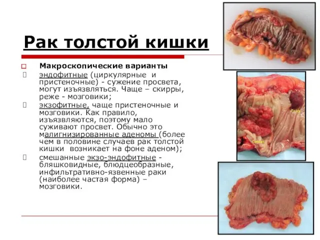 Рак толстой кишки Макроскопические варианты эндофитные (циркулярные и пристеночные) -