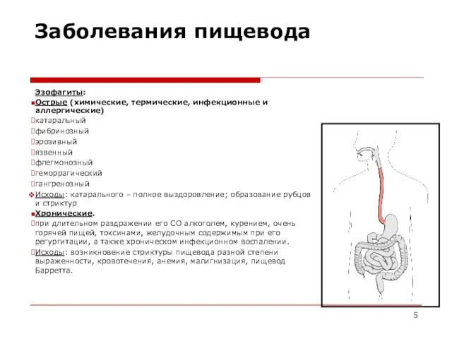 Заболевания пищевода Эзофагиты: Острые (химические, термические, инфекционные и аллергические) катаральный