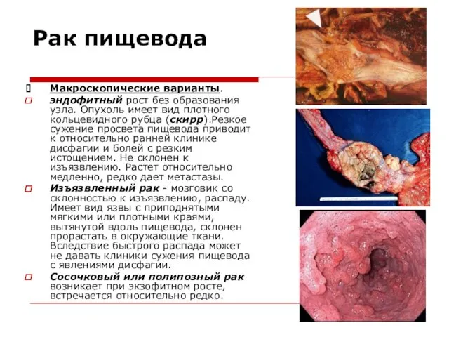 Рак пищевода Макроскопические варианты. эндофитный рост без образования узла. Опухоль