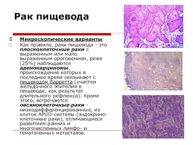 Рак пищевода Микроскопические варианты. Как правило, раки пищевода - это