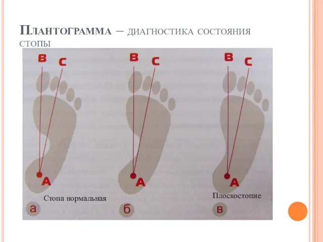 Плантограмма – диагностика состояния стопы Стопа нормальная Плоскостопие