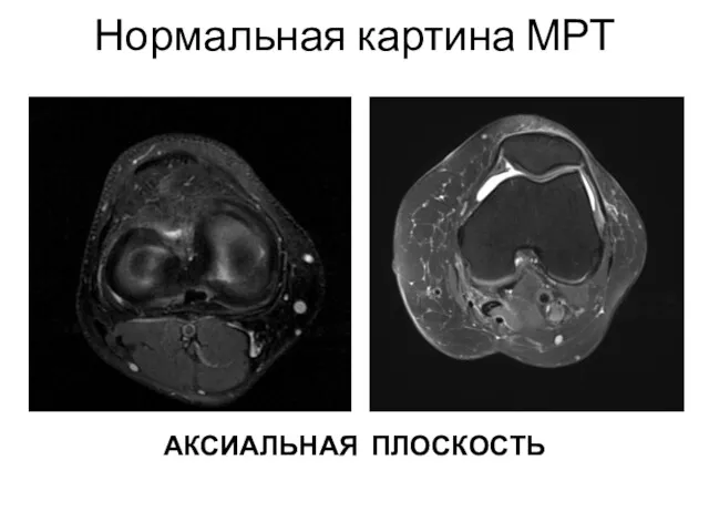 Нормальная картина МРТ АКСИАЛЬНАЯ ПЛОСКОСТЬ