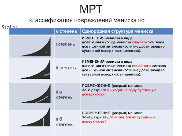 МРТ классификация повреждений мениска по Stoller