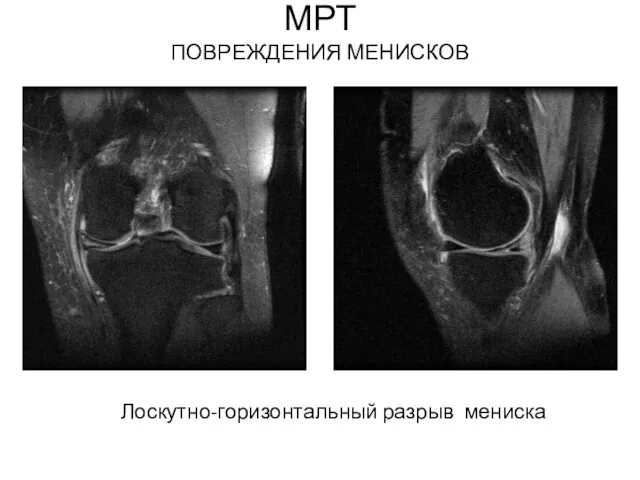 МРТ ПОВРЕЖДЕНИЯ МЕНИСКОВ Лоскутно-горизонтальный разрыв мениска