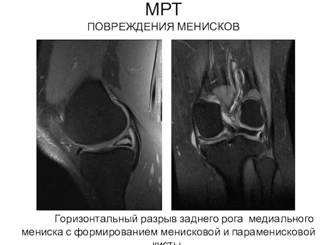 МРТ ПОВРЕЖДЕНИЯ МЕНИСКОВ Горизонтальный разрыв заднего рога медиального мениска с формированием менисковой и параменисковой кисты